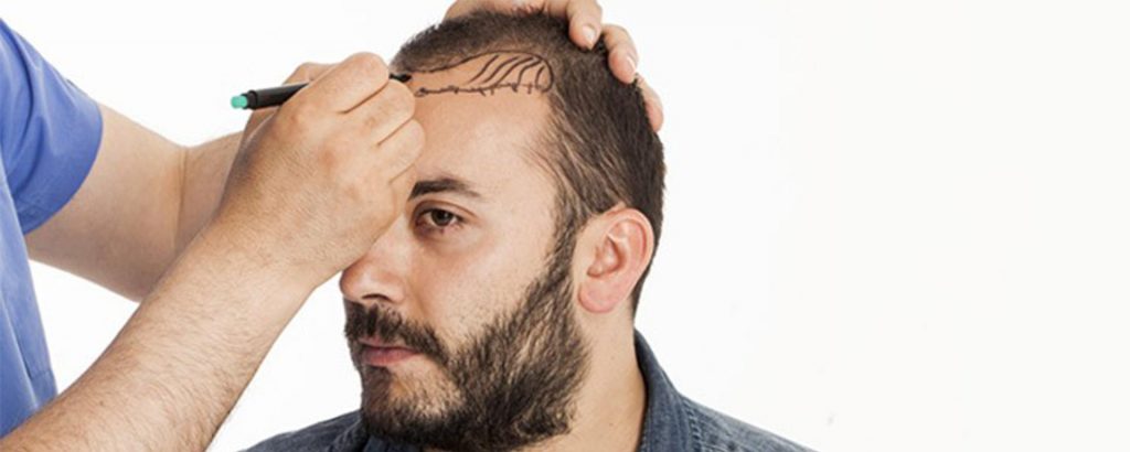 Saç Ekiminde Merak Edilenler